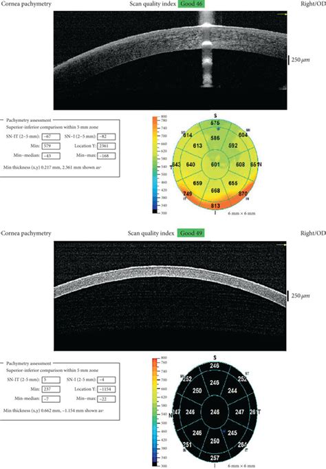 measuring corneal thickness with oct|anterior segment oct pachymeter.